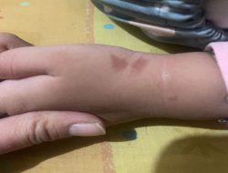 Bocah Taman Kanak-kanak Diduga Disiram Air Panas Oleh Kepala Sekolah